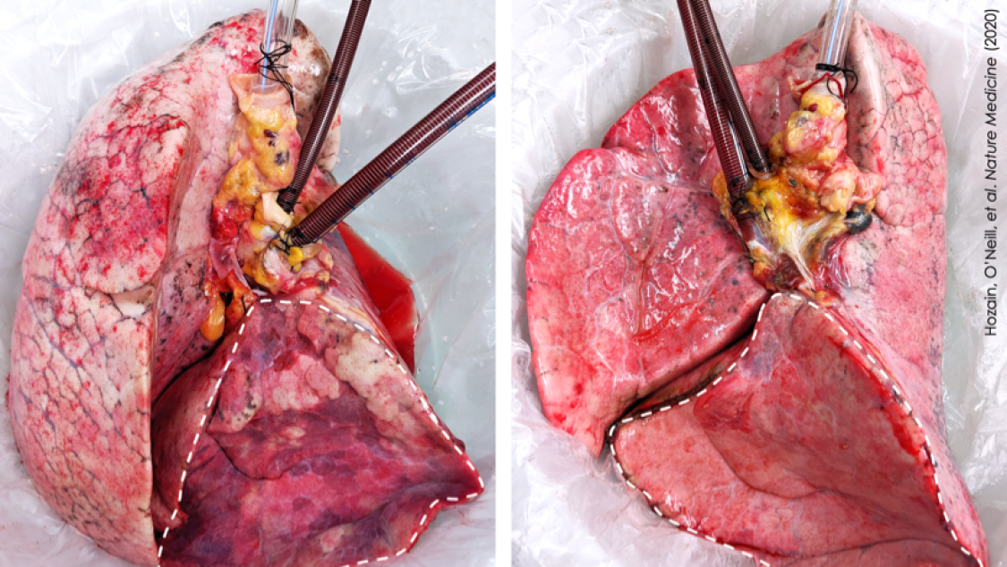 Human lung that failed on EVLP (left) and then recovered on cross-circulation (right).